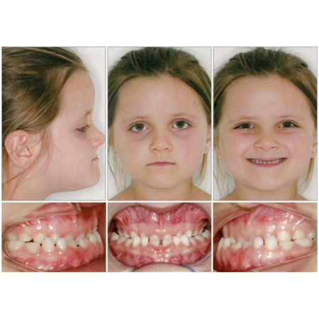 Skeletal Class III with total anterior and posterior crossbite: case report