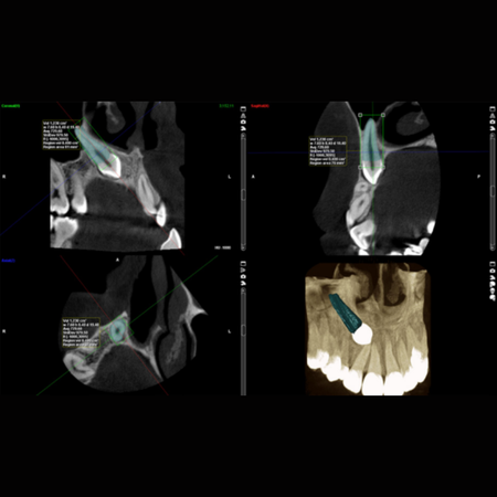 Medidas do volume radicular de caninos e incisivos laterais superiores em pacientes com impacção unilateral de caninos superiores