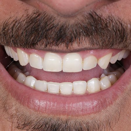 Alteração estética do sorriso associando Periodontia e Dentística em paciente com doença não cariosa: relato de caso com acompanhamento de 12 meses