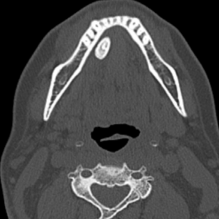Diagnosis and surgical treatment of sub- mandibular sialolithiasis: case report