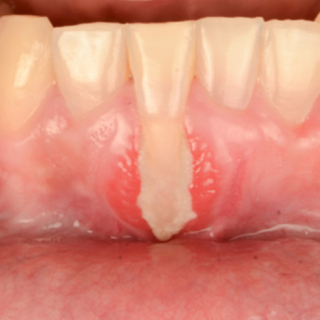 Multidisciplinary treatment of deep gingival recession in a mispositioned lower incisor: a case report