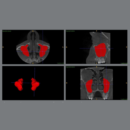 Volumetric changes in the maxillary sinus following orthodontic disimpaction of unilaterally impacted maxillary canines: a prospective CBCT-based split-mouth study