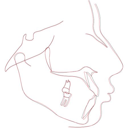 Treatment effects and lip profile changes following premolars extraction treatment vs fixed functional treatment in Class II division 1 malocclusion: A randomized controlled clinical trial