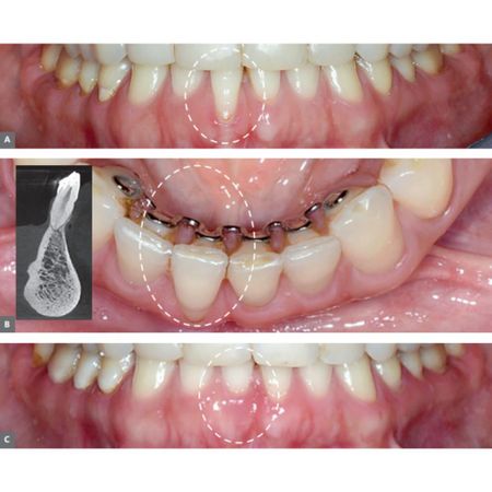 Recesiones gingivales en la superficie vestibular de los incisivos inferiores: ¡una lesión con etiopatogenia propia!