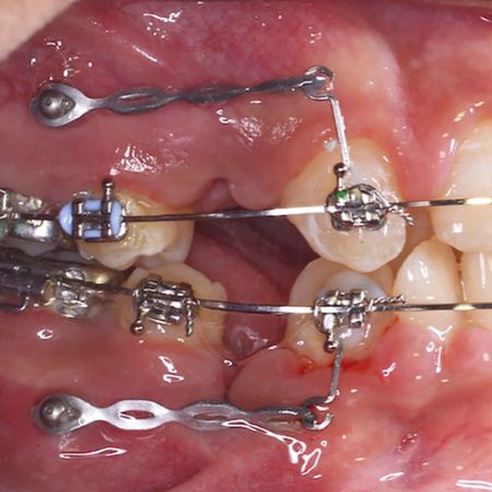 Retração de caninos ancorada em mini-implantes, com diferentes intervalos de reativação dos elásticos: um estudo randomizado controlado de boca dividida baseado em TCFC