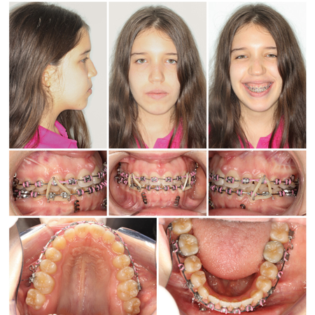 Camuflaje de Clase III esquelética en un paciente joven con asimetría mandibular, utilizando anclaje esquelético