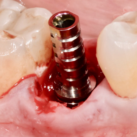 A importância do selamento biológico em implantes imediatos