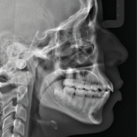 Class II subdivision correction with clear aligners and skeletal anchorage: a case report