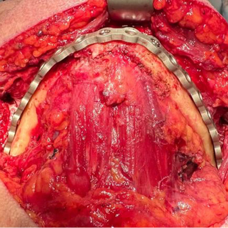 Atrophic mandibular fracture associated with dental implant placement: case report