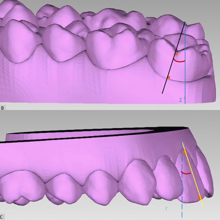 Previsibilidade dos alinhadores Invisalign® em pacientes adultos: um estudo retrospectivo dos movimentos angulares dos dentes