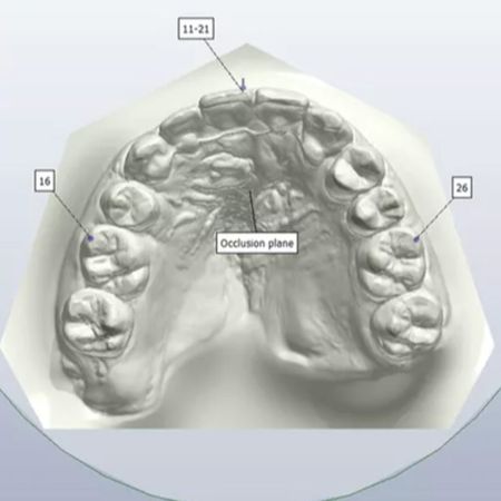 Closure of maxillary lateral incisor agenesis space in unilateral cleft lip and palate: a digital model assessment