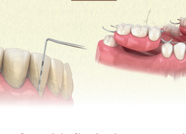 A influência do biofilme dental em prótese parcial removível: uma revisão de literatura