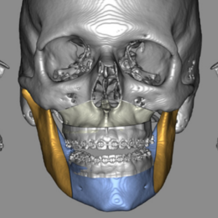 Comparison of the accuracy of an auto- matic occlusion method in computer si- mulation of orthognatic surgery
