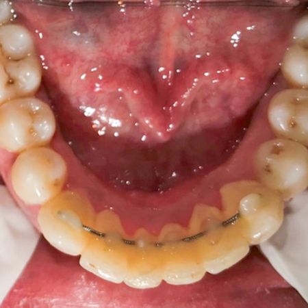 Comparison of multistranded wire and fiber-reinforced composite retainers effects on periodontium: A randomized clinical trial