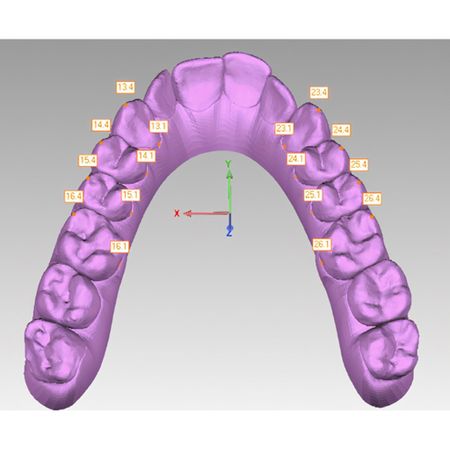 Accuracy of arch expansion with two thermoplastic materials in Invisalign® patients: EX30® and SmartTrack®