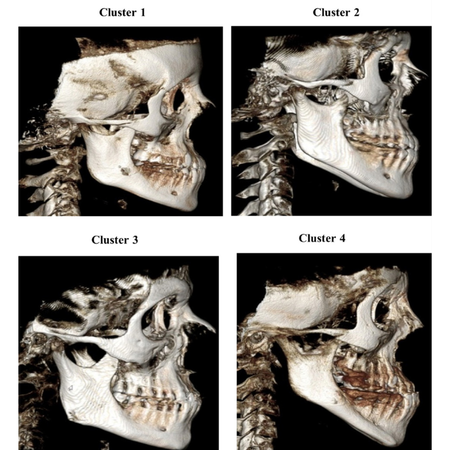 Phenotypic characterization of Class III malocclusion using three-dimensional analysis on a sample of Yemeni population: a retrospective cross-sectional study
