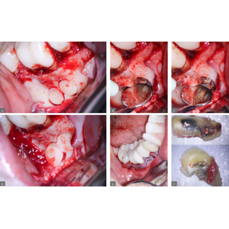 Static guided endodontic surgery