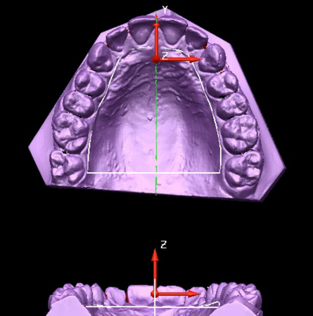 Avaliação das dimensões do palato em diferentes padrões faciais, usando modelos digitais