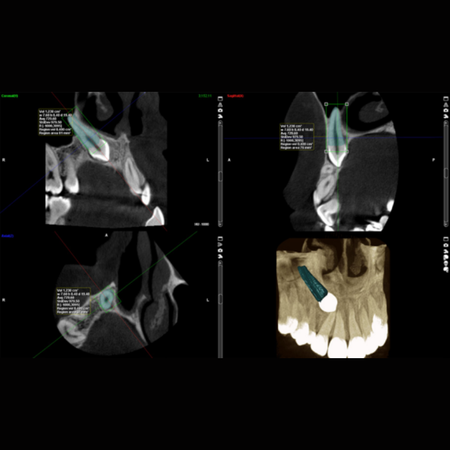 Root volume measurements of maxillary canines and lateral incisors in patients with unilateral maxillary canine impaction