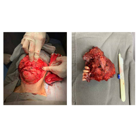 Diagnosis and treatment of myxoid chondrosarcoma in the mandible – case report