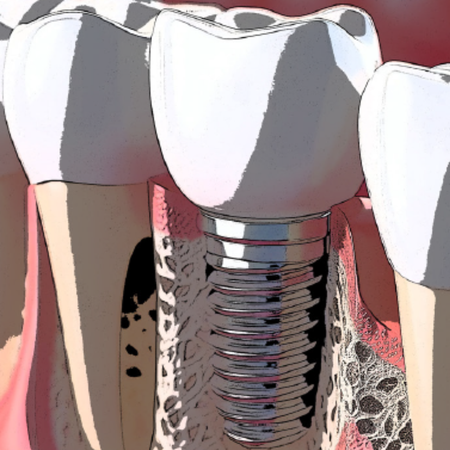 Comparison of low-speed drilling without irrigation and high-speed drilling with irrigation on peri-implant crestal bone loss and implant success: a systematic review with meta-analysis