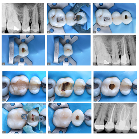Pre-endodontic restorations: case series