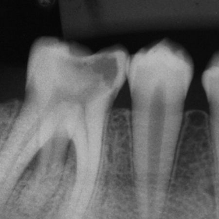 Permanent mandibular first molar with radix entomolaris: A case report of an unusual occurrence
