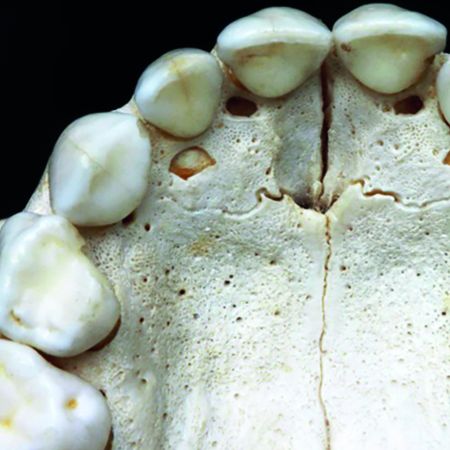 O incisivo lateral superior, ou “smiling teeth”, é o dente com forma e posição mais instáveis. Por quê?