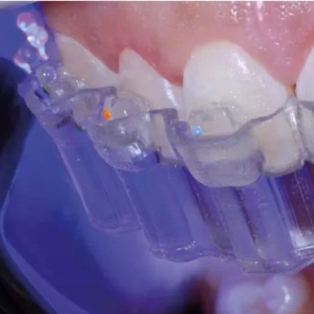 Indirect digital bonding: Case report