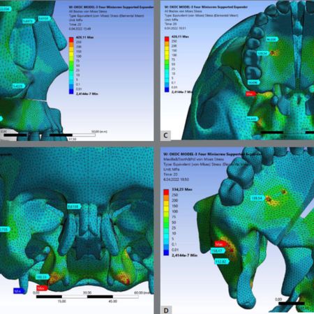 Effect of different palatal expanders with miniscrews in surgically assisted rapid palatal expansion: A non-linear finite element analysis