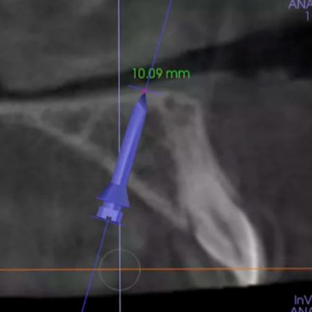 Class III treatment with mini-implants anchorage in young adult patients: short and long-term results