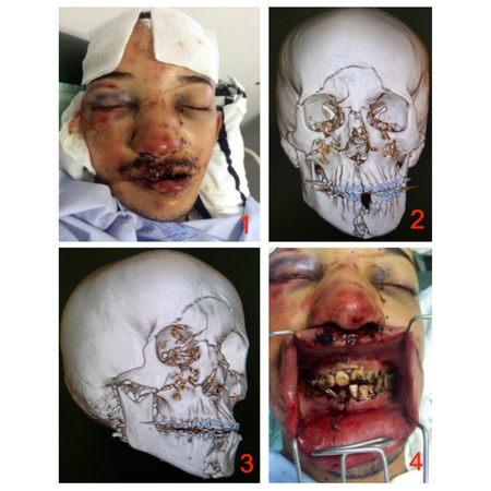 Management of panfacial fractures: case report