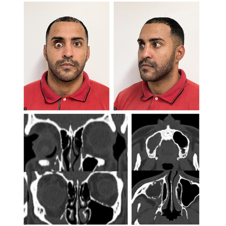 Reconstruction of the orbital floor through digital surgical planning: case report