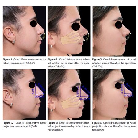 Measurements os Projection And Rotation Of The Nasal Tip In Primary Rhinoseptoplasty: a Literature Review