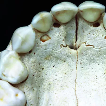 The maxillary lateral incisor, or “smiling teeth”, is the tooth with the most unstable shape and position. Why is this?