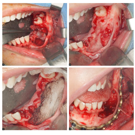 Conservative treatment of unicystic ameloblastoma in adolescent: 10-year follow-up