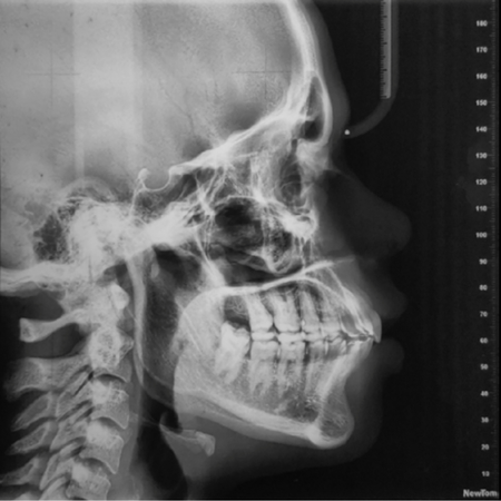 Extraction of maxillary first molars in protrusive Class II division 1 malocclusion