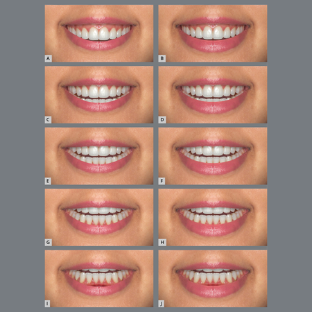 Influence of incisor display and lower lip height on smile esthetics and perceived age