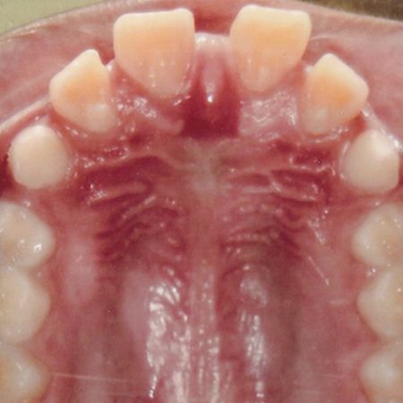 Angle Class II malocclusion treated with functional appliance and fixed appliance with mandibular propulsor, in a patient with Autism Spectrum Disorder