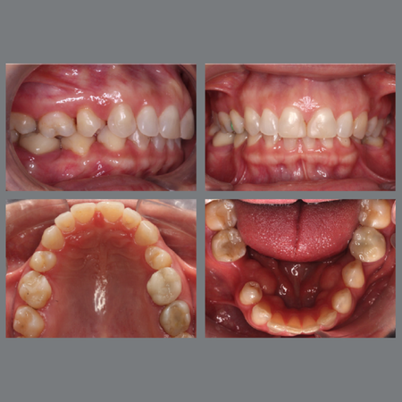 Orthodontic creative mechanics