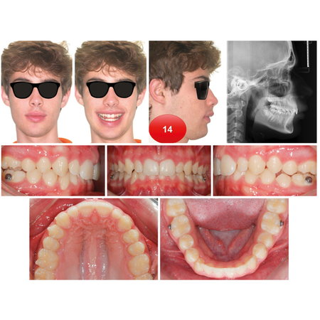 Tratamento de Classe Il usando uma estratégia biomecânica para avanço mandibular com alinhadores