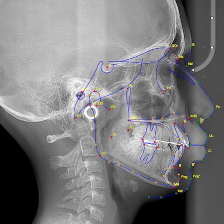 Accuracy of cephalometric landmark identification on artificial intelligence-based software: a comparative study