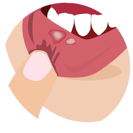 Fibroma ossificante periférico maxilar gigante: relato de caso
