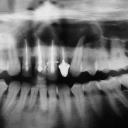 Surgical retreatment of a large cyst by means of decompression with special devices