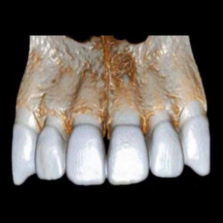 Aseptic pulp necrosis as a cause of chronic periapical lesion in a tooth with dental subluxation