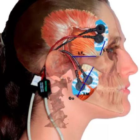 Response of masticatory muscles to treatment with orthodontic aligners: a preliminary prospective longitudinal study