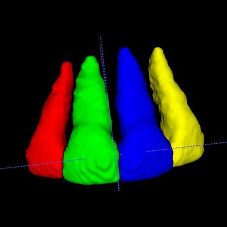 Impact of low intensity pulsed ultrasound on volumetric root resorption of maxillary incisors in patients treated with clear aligner therapy: A retrospective study