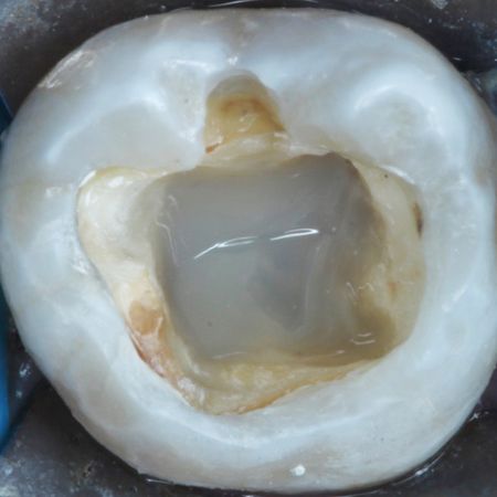 Endodontically-treated teeth restoration strategy using bulk-fill resin: clinical cases reports