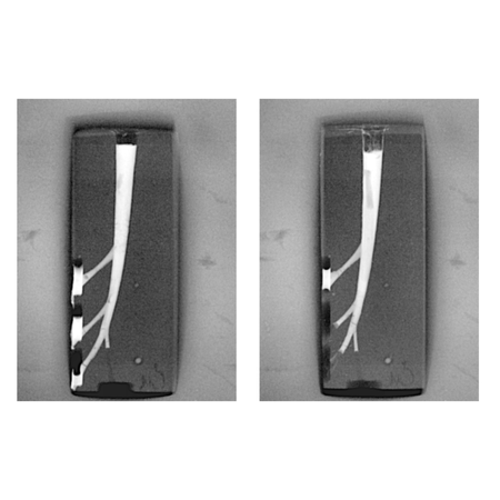 Evaluation of lateral canal filling capability in thermoplastic obturation techniques