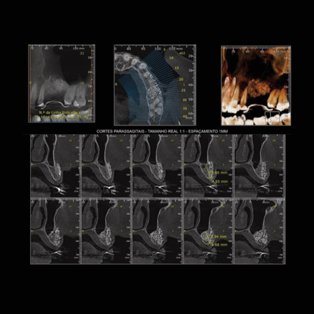 Dental implants rehabilitation after bone reconstruction using Sticky Bone technique: case report